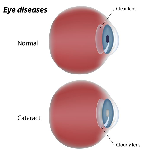 Hartsdale Cataracts