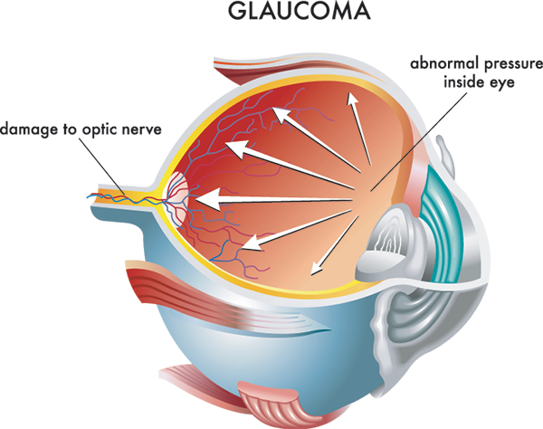 Hartsdale Glaucoma