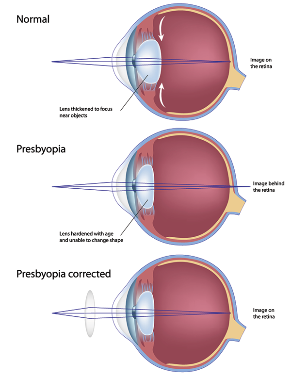 Hartsdale Presbyopia
